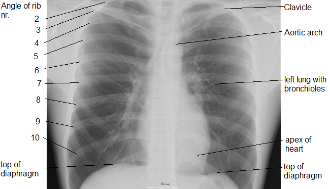 Could lung coils be the new treatment for COPD? - Oxygen Worldwide